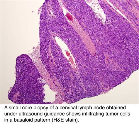 hpv positive squamous cell carcinoma